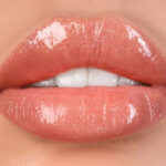 juvederm-westlake-village-plump-lips-dr-bhuiya-injectables-dermal-fillers2