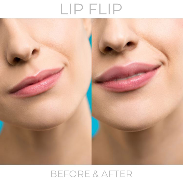 lip-flip-botox-injection-before-after-westlake-village-dr-bhuiya2