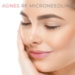 Agnes-RF-Microneedling-westlake-village-dr-bhuiya-remove-fat