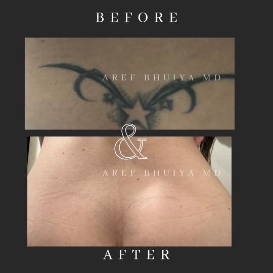 laser tattoo removal dr bhuiya westlake village