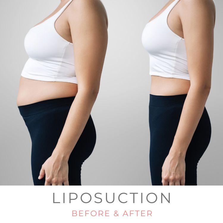 abdomen-flanks-liposuction-before-after-westlake-village-dr-bhuiya