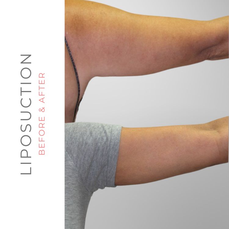 arm-liposuction-before-after-westlake-village-dr-bhuiya