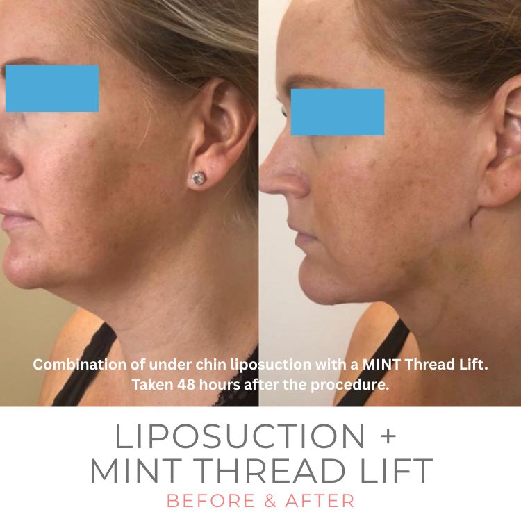under-chin-liposuction-westlake-village-dr-bhuiya-Mint-thread-lift