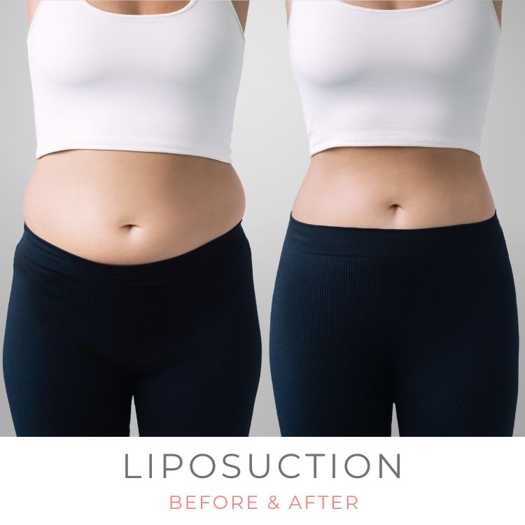 vaser-liposuction-abdomen-westlake-village-dr-bhuiya