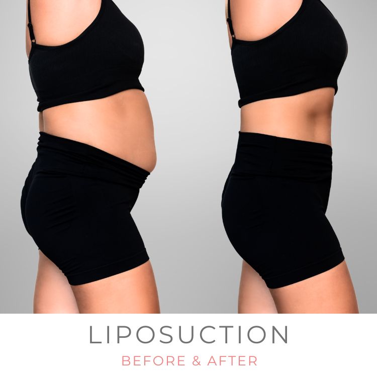 vaser-liposuction-before-after-westlake-village-dr-bhuiya-abdomen-belly