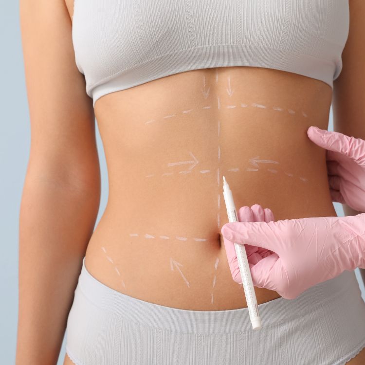vaser-liposuction-westlake-village-dr-bhuiya-abdomen
