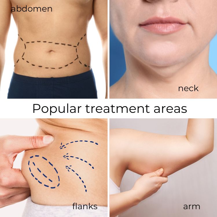vaser-liposuction-westlake-village-dr-bhuiya-popular-treatment-areas